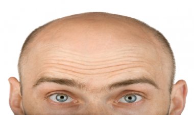 Saç Ekimi Teknikleri