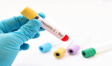 290 Milyon Kişi Hepatitli Olduğunu Bilmeden Yaşıyor!