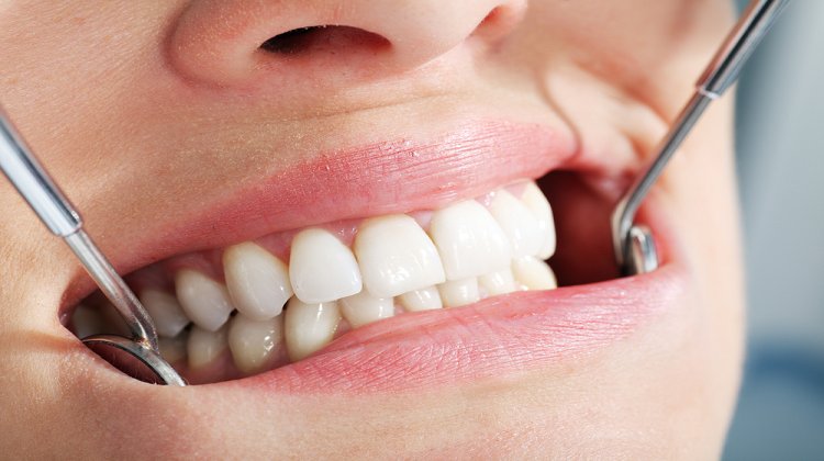 Diş Estetiği Nedir,  Nasıl Yapılır?