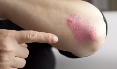 Dikkat: Bu Besinler Sedef Hastalığını Alevlendiriyor!