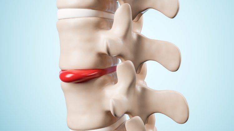 Bel ve Boyun Fıtıkları Ameliyatsız Tedavi Edilebilir Mi? Uzmanı Anlattı