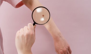 Önemsenmeyen Benler Kanser Habercisi Olabilir!