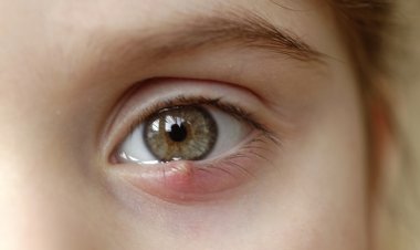 Arpacık Deyip Geçmeyin: Göz Bozukluğuna İşaret Ediyor!