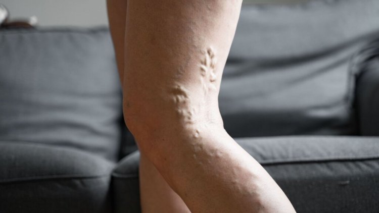 Bacaklarda Damar Tıkanıklığına Yol Açan 8 Etkene Dikkat