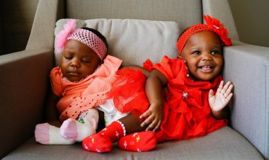 Türk Doktorlar Kamerunlu Yapışık İkizler İçin Seferber Oldu