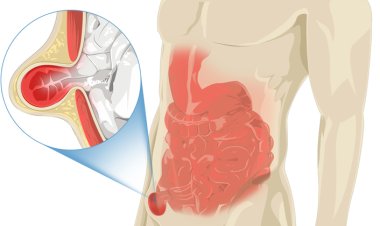 Kronik Öksürük ve Ağır Yük Kaldırma Kasık Fıtığı Sebebi