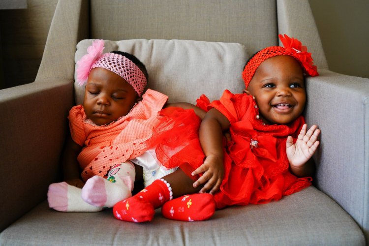 Türk Doktorlar Kamerunlu Yapışık İkizler İçin Seferber Oldu