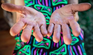 Ellerdeki Morarma ve Kızarıklık Raynaud Sendromu İşareti