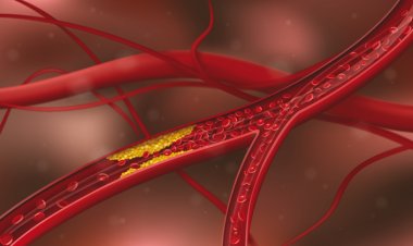Kolesterolünüzün Huyu İyi mi Kötü mü?