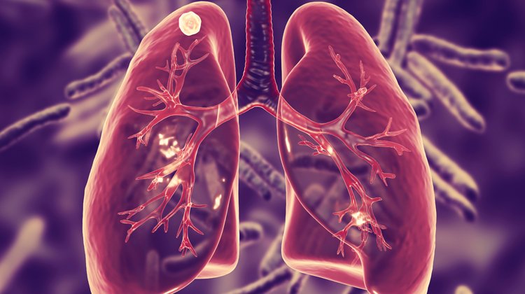 Akciğer Kanseri’nde İmmunoterapi Tedavileri Uzlaşı Raporu Yayımlandı!