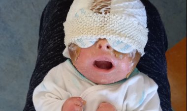 500 Binde 1 Görülüyor! Kaplumbağa Kabuklu Kız Hayata Tutunmayı Başardı