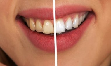 Evde 'Dişlerimi Beyazlatayım' Derken Sağlığınızdan Olmayın