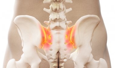 Kalçada Sinsice İlerleyen  Kalça Avasküler Nekrozu Nedir?