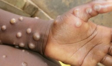 Pfizer’den Maymun Çiçeği Açıklaması