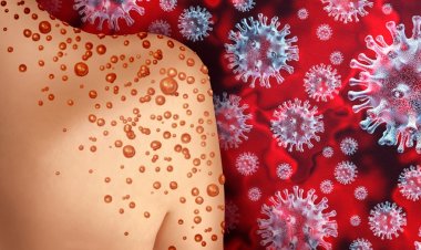 Maymun Çiçeği Döküntüsünü Alerjik Döküntüden Ayırmanın Yolları