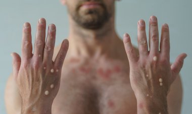 Sağlık Bakanlığı'dan ‘Maymun Çiçeği’ Rehberi