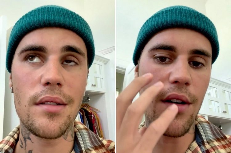 Justin Bieber’ın Yüzünü Felç Eden Ramsay Hunt Sendromu Nedir?