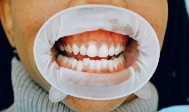 Diş Eti Çekilmesi Neden Olur? Diş Eti Çekilmesi Nasıl Önlenir?