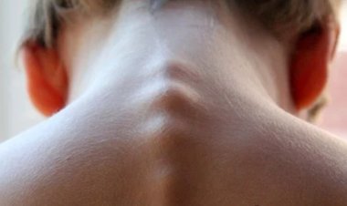 Okul Çağı Çocuklarında Skolyoz Belirtileri