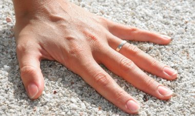 Yüzüğünüz Parmağınıza Dar Geliyorsa Akromegali Hastası Olabilirsiniz