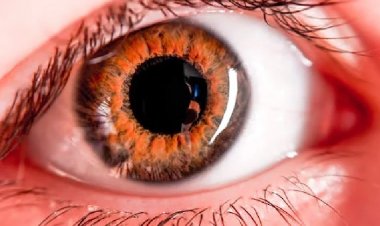 Uyuz Vakaları Arttı! Uyuzdan Gözlerimizi Nasıl Korumalıyız?