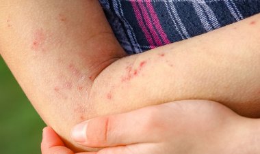 Klimik'ten Kızamık Salgını Uyarısı